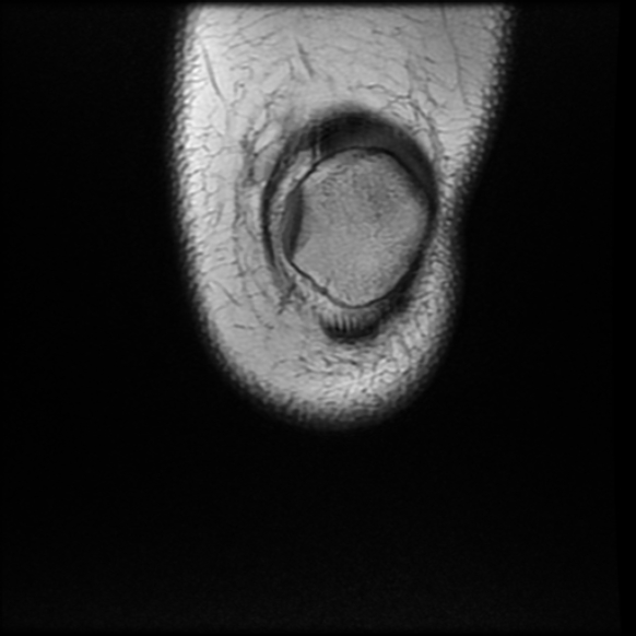 File:Anterior cruciate ligament tear, Wrisberg rip and bucket-handle tear of medial meniscus (Radiopaedia 75872-87266 Coronal T1 3).jpg