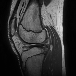 Anterior cruciate ligament tear - pediatric (Radiopaedia 62152-70260 Sagittal PD 109).jpg