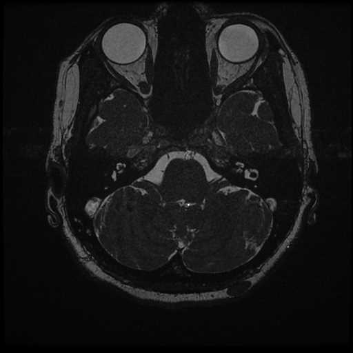 Anterior inferior cerebellar artery vascular loop - type II (Radiopaedia 70991-81209 Axial 3D FIESTA 45).jpg