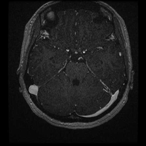 Anterior inferior cerebellar artery vascular loop - type II (Radiopaedia 70991-81209 Axial T1 C+ 9).jpg