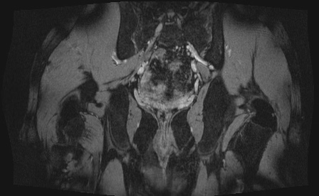 Anterior inferior iliac spine avulsion fracture (Radiopaedia 81312-95000 G 4).jpg