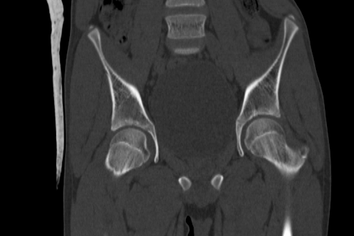Anterior inferior iliac spine avulsion injury (Radiopaedia 88666-105376 Coronal bone window 33).jpg