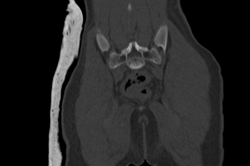 Anterior inferior iliac spine avulsion injury (Radiopaedia 88666-105376 Coronal bone window 60).jpg