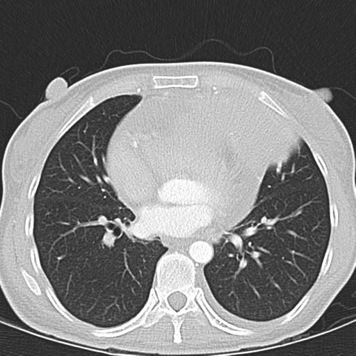 Anterior mediastinal lymphoma (Radiopaedia 29556-30061 Axial lung window 33).jpg