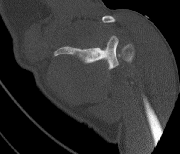 Anterior shoulder dislocation with Hill-Sachs and bony Bankart lesions (Radiopaedia 40424-42974 Coronal bone window 32).png