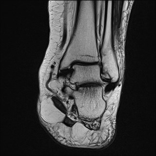 File:Anterior talofibular ligament injury - rupture with soft-tissue impingement (Radiopaedia 38765-40928 Coronal T2 14).jpg