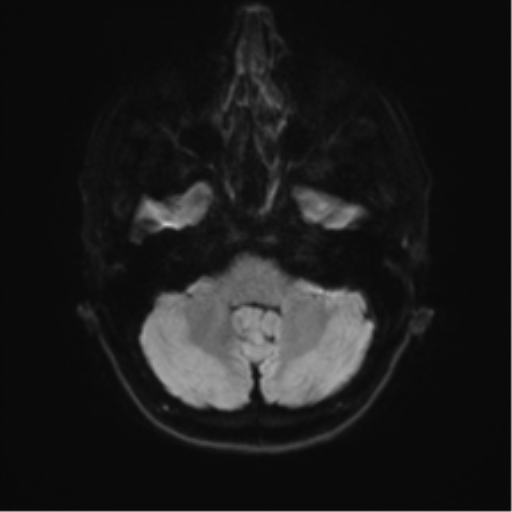 File:Anterior temporal lobe perivascular space (Radiopaedia 40946-43650 Axial DWI 32).png