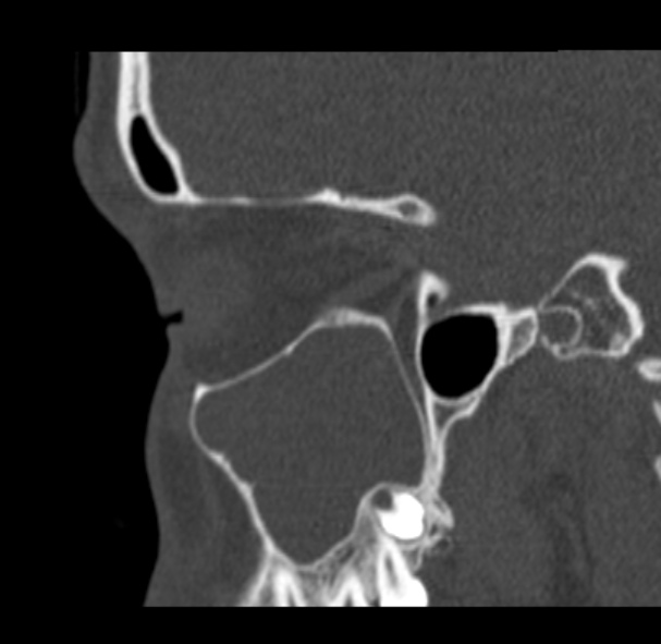 File:Antrochoanal polyp (Radiopaedia 33984-35202 Sagittal bone window 23).jpg
