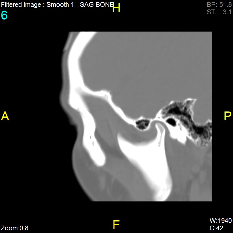 Antrochoanal polyp (Radiopaedia 65101-74094 Sagittal bone window 6).jpg