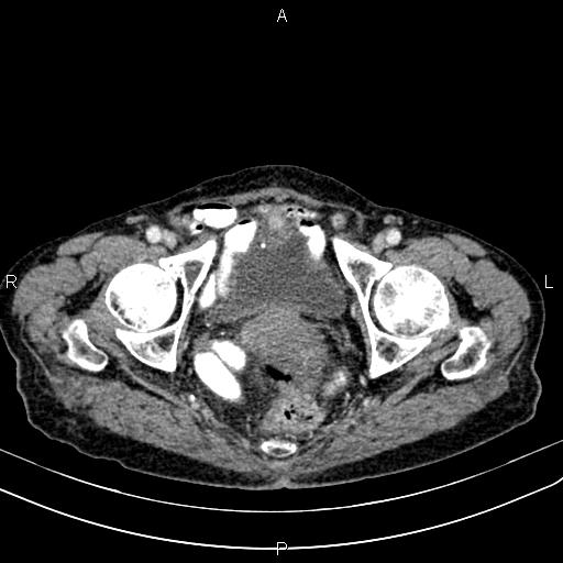 File:Aortic aneurysm and Lemmel syndrome (Radiopaedia 86499-102554 A 75).jpg