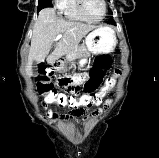 Aortic aneurysm and Lemmel syndrome (Radiopaedia 86499-102554 C 13).jpg