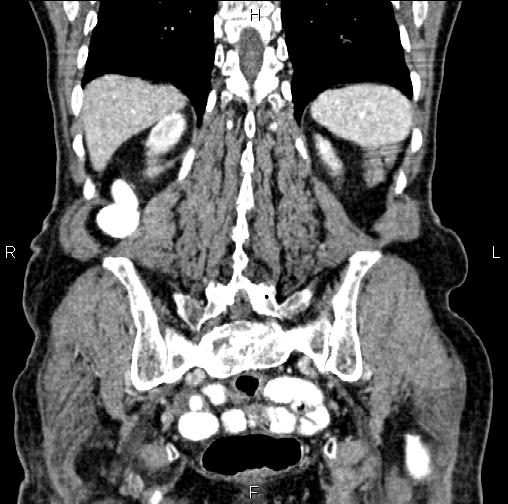 File:Aortic aneurysm and Lemmel syndrome (Radiopaedia 86499-102554 C 51).jpg
