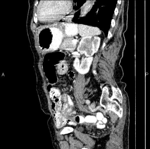 Aortic aneurysm and Lemmel syndrome (Radiopaedia 86499-102554 D 60).jpg