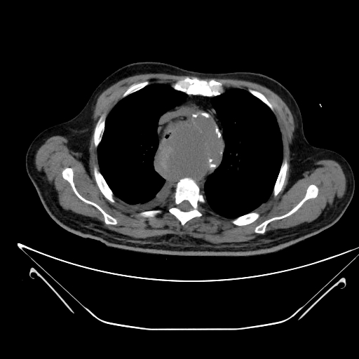 File:Aortic arch aneurysm (Radiopaedia 84109-99365 Axial non-contrast 87).jpg