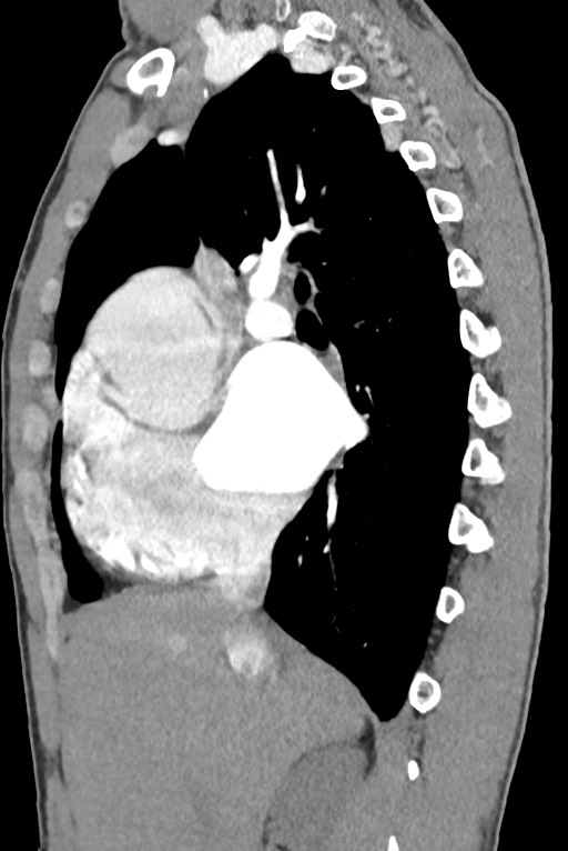 Aortic coarctation with aneurysm (Radiopaedia 74818-85828 B 64).jpg