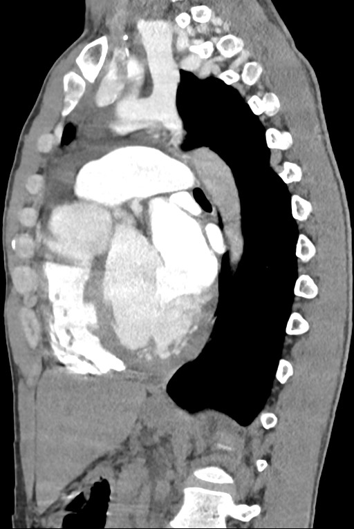 Aortic coarctation with aneurysm (Radiopaedia 74818-85828 B 96).jpg