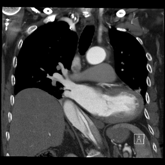 Aortic dissection (CTPA) (Radiopaedia 75506-86750 B 35).jpg
