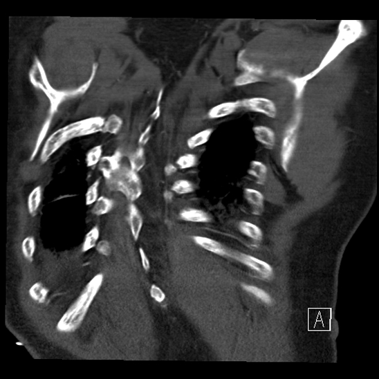 File:Aortic dissection (CTPA) (Radiopaedia 75506-86750 B 67).jpg