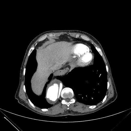 Aortic dissection (Radiopaedia 27466-27665 C+ arterial phase 237).jpg