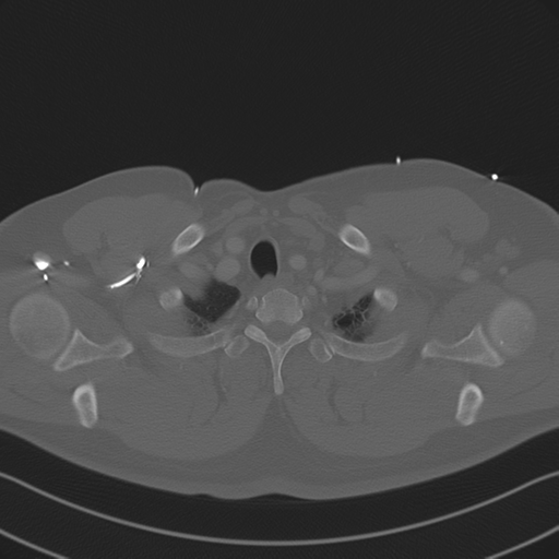 Aortic dissection (Radiopaedia 50763-56234 Axial bone window 15).png