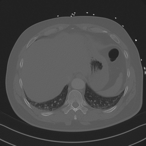 Aortic dissection (Radiopaedia 50763-56234 Axial bone window 85).png