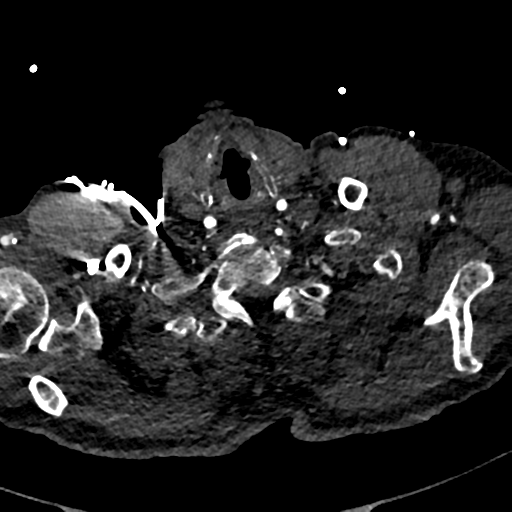 Aortic dissection - DeBakey type II (Radiopaedia 64302-73082 A 6).png