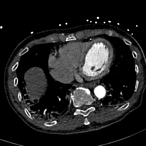 File:Aortic dissection - DeBakey type II (Radiopaedia 64302-73082 A 66).png