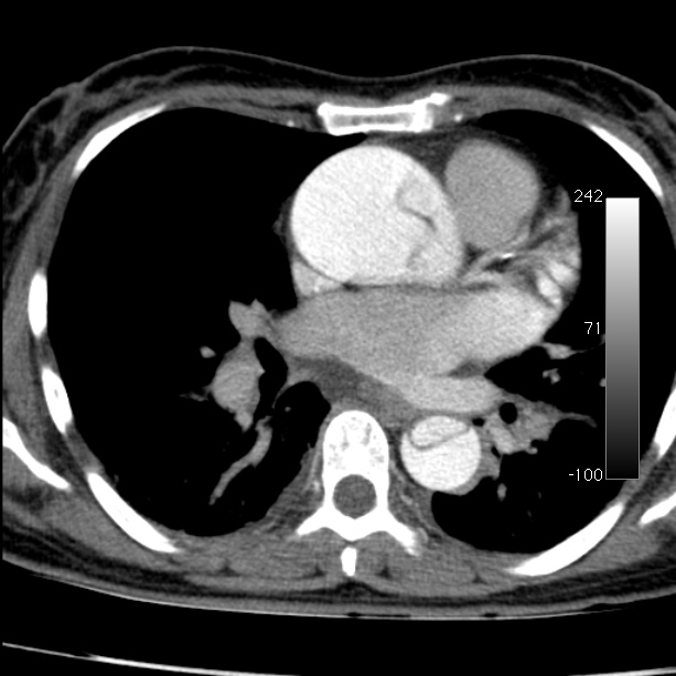 Aortic dissection - Stanford type A (Radiopaedia 29247-29659 A 42).jpg