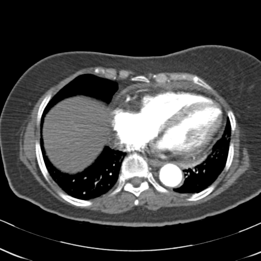 File:Aortic dissection - Stanford type A (Radiopaedia 39073-41259 A 55).png