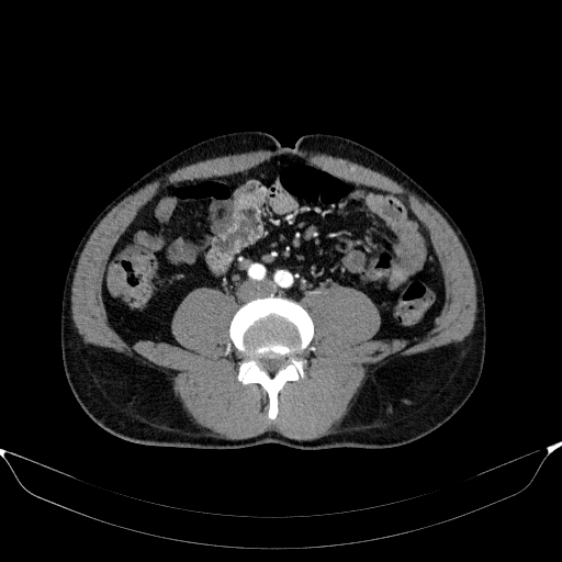 File:Aortic dissection - Stanford type A (Radiopaedia 83418-98500 A 90).jpg