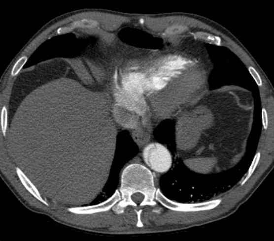 Aortic dissection - Stanford type B (Radiopaedia 73648-84437 A 92).jpg