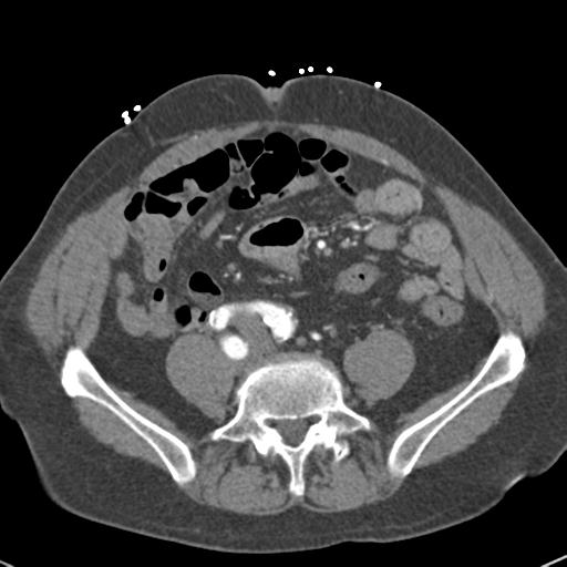 Aortic intramural hematoma (Radiopaedia 31139-31838 B 127).jpg