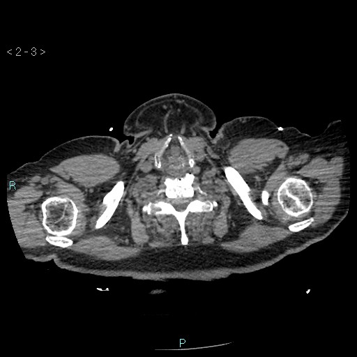Aortic intramural hematoma (Radiopaedia 48463-53380 Axial non-contrast 1).jpg