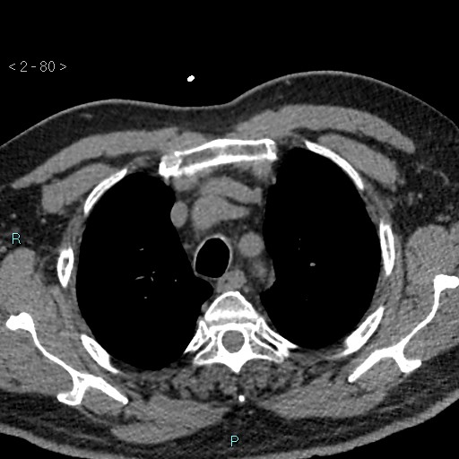 Aortic intramural hematoma (Radiopaedia 48463-53380 Axial non-contrast 36).jpg