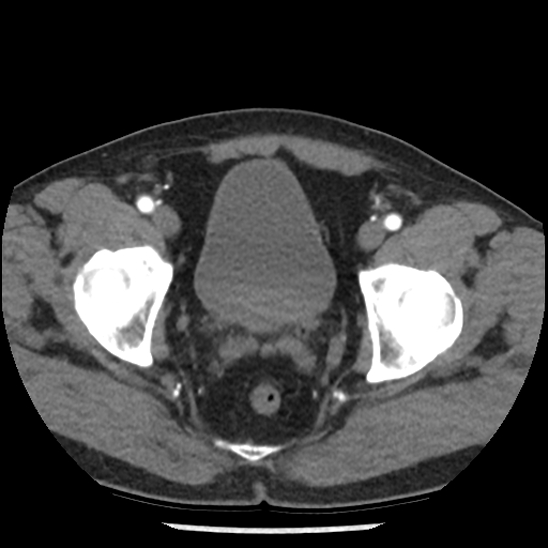 Aortic intramural hematoma (type B) (Radiopaedia 79323-92387 B 108).jpg