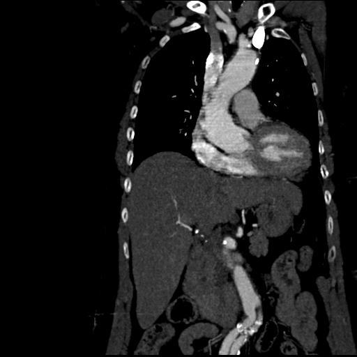 Aortic intramural hematoma from penetrating atherosclerotic ulcer (Radiopaedia 31137-31836 C 25).jpg