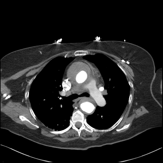 Aortic intramural hematoma with dissection and intramural blood pool (Radiopaedia 77373-89491 B 51).jpg