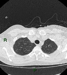 File:Aortic valve endocarditis (Radiopaedia 87209-103485 Axial lung window 21).jpg