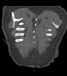 File:Aortic valve endocarditis (Radiopaedia 87209-103485 D 5).jpg