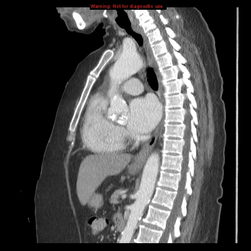 File:Aortic valve stenosis (Radiopaedia 14480-14423 B 2).jpg