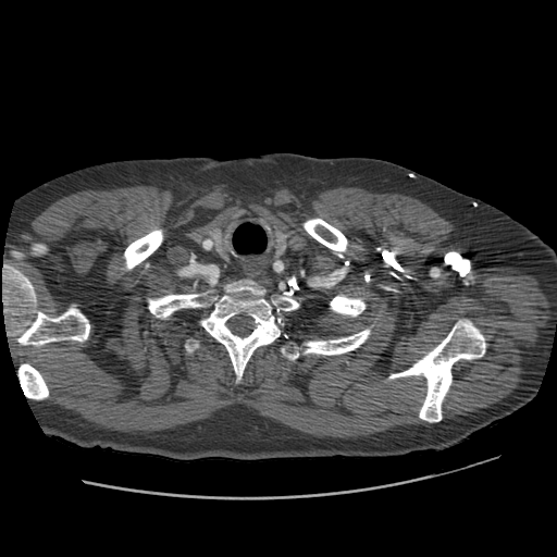 File:Aorto-coronary bypass graft aneurysms (Radiopaedia 40562-43157 A 12).png