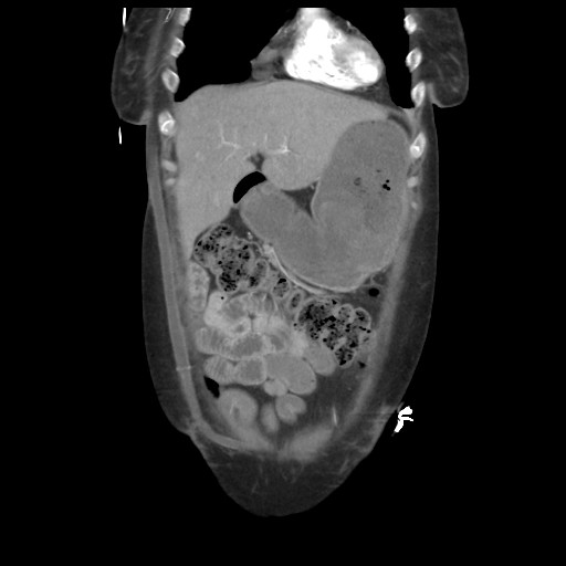 File:Aorto-duodenal fistula (Radiopaedia 25668-25850 B 15).jpg