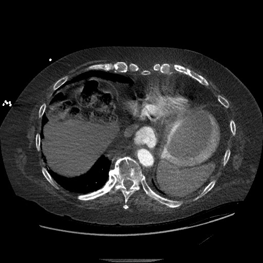 Aortoesophageal fistula with endovascular repair (Radiopaedia 73781-84592 Axial C+ CTPA 136).jpg