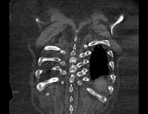 Aortoesophageal fistula with endovascular repair (Radiopaedia 73781-84592 Coronal C+ CTPA 125).jpg