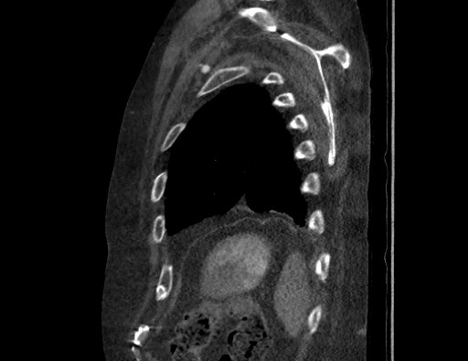 Aortoesophageal fistula with endovascular repair (Radiopaedia 73781-84592 Sagittal C+ CTPA 173).jpg