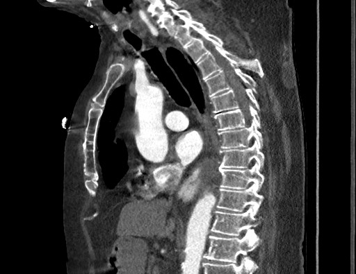Aortoesophageal fistula with endovascular repair (Radiopaedia 73781-84592 Sagittal C+ CTPA 98).jpg