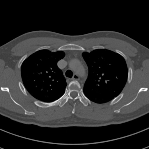 Apical lung mass mimic - neurogenic tumor (Radiopaedia 59918-67521 Axial bone window 23).jpg