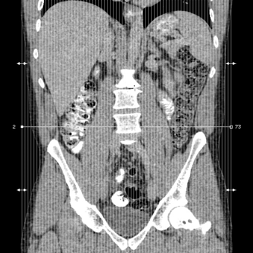 Appendicitis complicated by post-operative collection (Radiopaedia 35595-37114 C 1).jpg