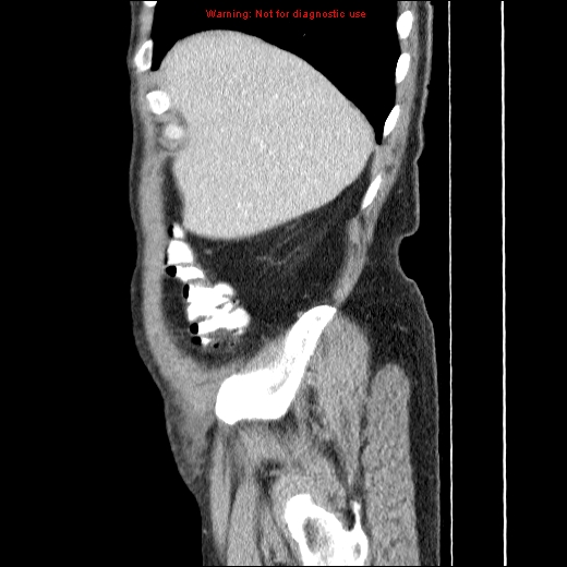 File:Appendicitis mass in inguinal hernia (Radiopaedia 26858-27029 C 5).jpg
