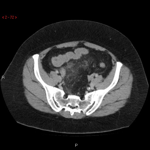 Appendicitis with microperforation- promontoric type (Radiopaedia 27268-27442 C 60).jpg